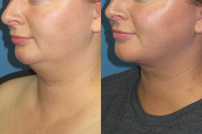 Before & After Liposuction - Neck / Precision TX Face & Neck Case 198 Left Oblique View in Coeur d'Alene, ID