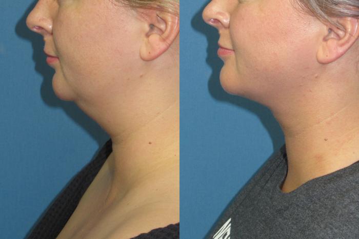 Before & After Liposuction - Neck / Precision TX Face & Neck Case 198 Left Side View in Coeur d'Alene, ID