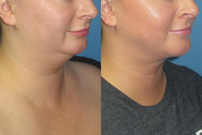 Before & After Liposuction - Neck / Precision TX Face & Neck Case 198 Right Oblique View in Coeur d'Alene, ID