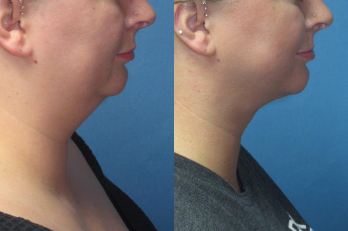 Before & After Liposuction - Neck / Precision TX Face & Neck Case 198 Right Side View in Coeur d'Alene, ID