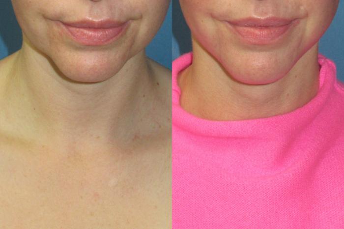 Before & After Liposuction - Neck / Precision TX Face & Neck Case 199 Front View in Coeur d'Alene, ID