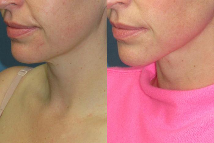 Before & After Liposuction - Neck / Precision TX Face & Neck Case 199 Left Oblique View in Coeur d'Alene, ID