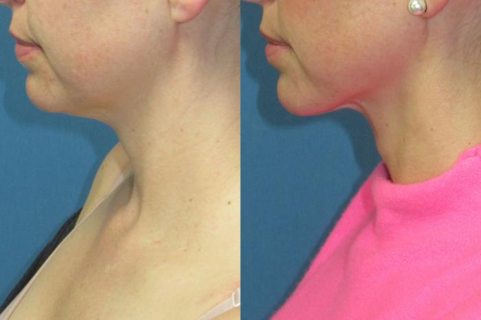 Before & After Liposuction - Neck / Precision TX Face & Neck Case 199 Left Side View in Coeur d'Alene, ID