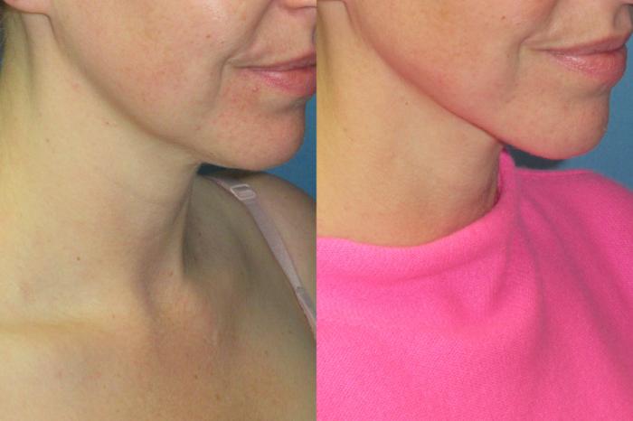 Before & After Liposuction - Neck / Precision TX Face & Neck Case 199 Right Oblique View in Coeur d'Alene, ID