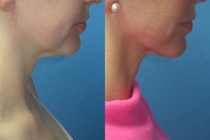 Before & After Liposuction - Neck / Precision TX Face & Neck Case 199 Right Side View in Coeur d'Alene, ID