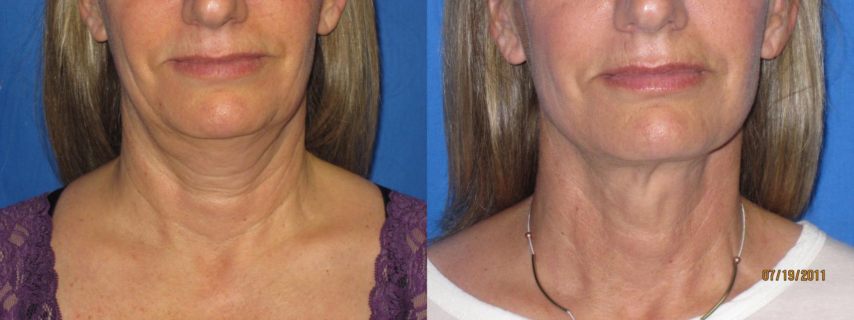 Before & After Liposuction - Neck / Precision TX Face & Neck Case 20 View #1 View in Coeur d'Alene, ID