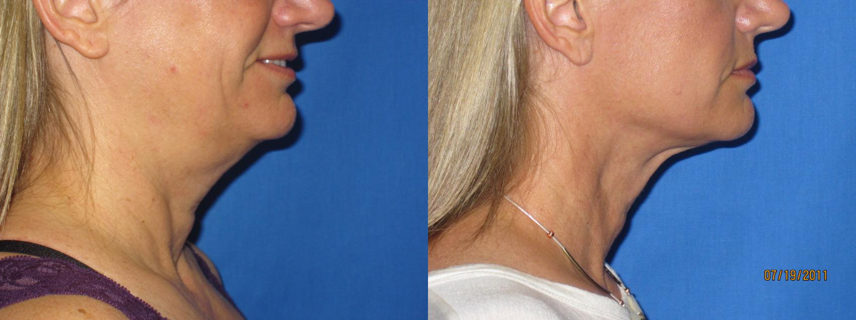 Before & After Liposuction - Neck / Precision TX Face & Neck Case 20 View #2 View in Coeur d'Alene, ID