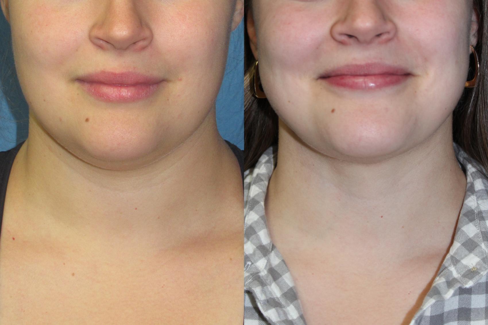 Before & After Liposuction - Neck / Precision TX Face & Neck Case 203 Front View in Coeur d'Alene, ID