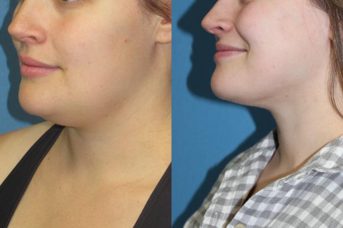 Before & After Liposuction - Neck / Precision TX Face & Neck Case 203 Left Oblique View in Coeur d'Alene, ID