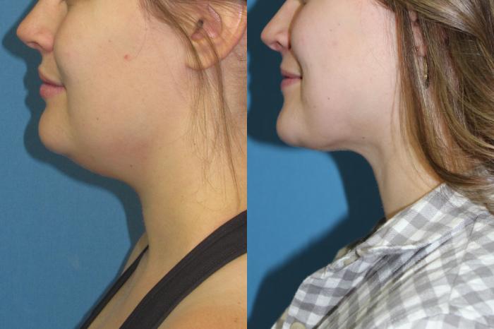 Before & After Liposuction - Neck / Precision TX Face & Neck Case 203 Left Side  View in Coeur d'Alene, ID