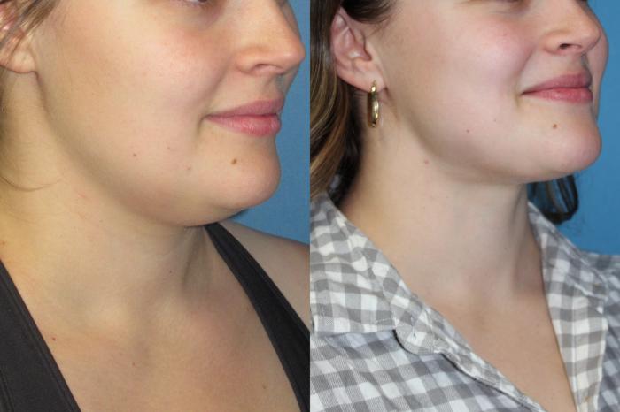 Before & After Liposuction - Neck / Precision TX Face & Neck Case 203 Right Oblique View in Coeur d'Alene, ID