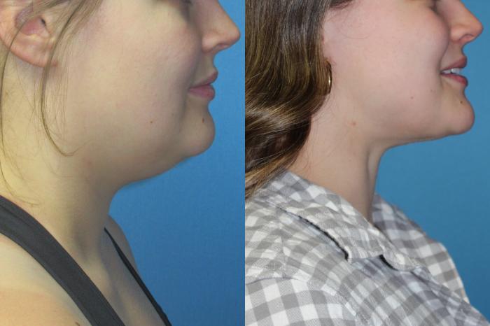 Before & After Liposuction - Neck / Precision TX Face & Neck Case 203 Right Side View in Coeur d'Alene, ID