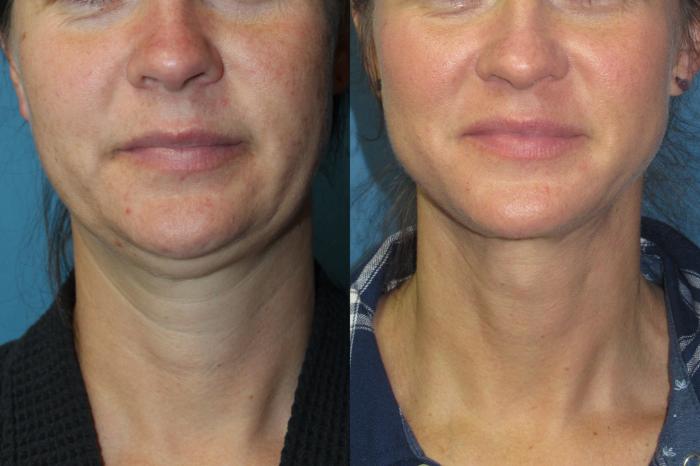 Before & After Liposuction - Neck / Precision TX Face & Neck Case 206 Front View in Coeur d'Alene, ID