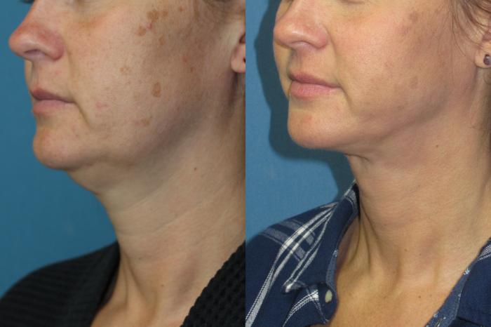 Before & After Liposuction - Neck / Precision TX Face & Neck Case 206 Left Oblique View in Coeur d'Alene, ID