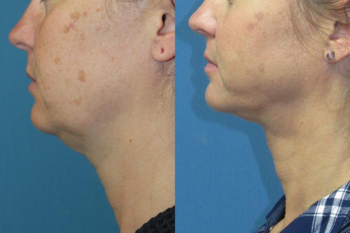 Before & After Liposuction - Neck / Precision TX Face & Neck Case 206 Left Side View in Coeur d'Alene, ID