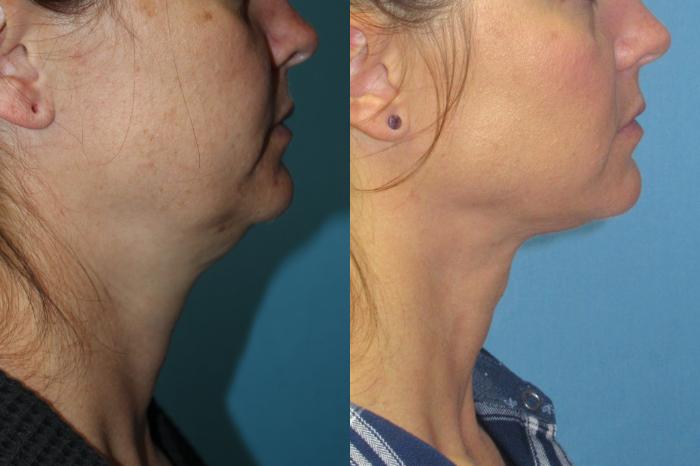 Before & After Liposuction - Neck / Precision TX Face & Neck Case 206 Right Oblique View in Coeur d'Alene, ID