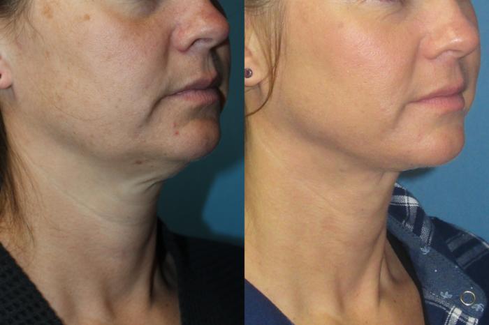 Before & After Liposuction - Neck / Precision TX Face & Neck Case 206 Right Side View in Coeur d'Alene, ID