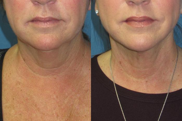 Before & After Liposuction - Neck / Precision TX Face & Neck Case 210 Front View in Coeur d'Alene, ID