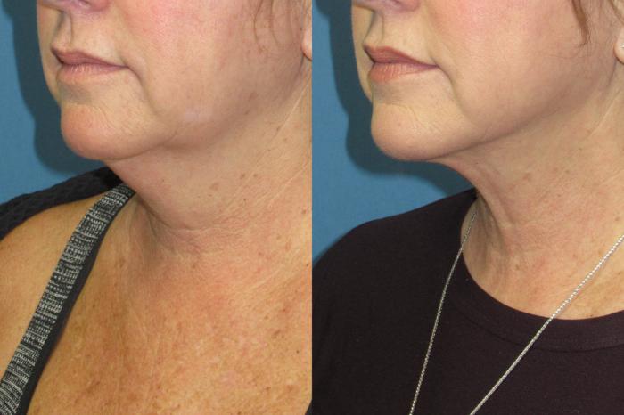 Before & After Liposuction - Neck / Precision TX Face & Neck Case 210 Left Oblique View in Coeur d'Alene, ID