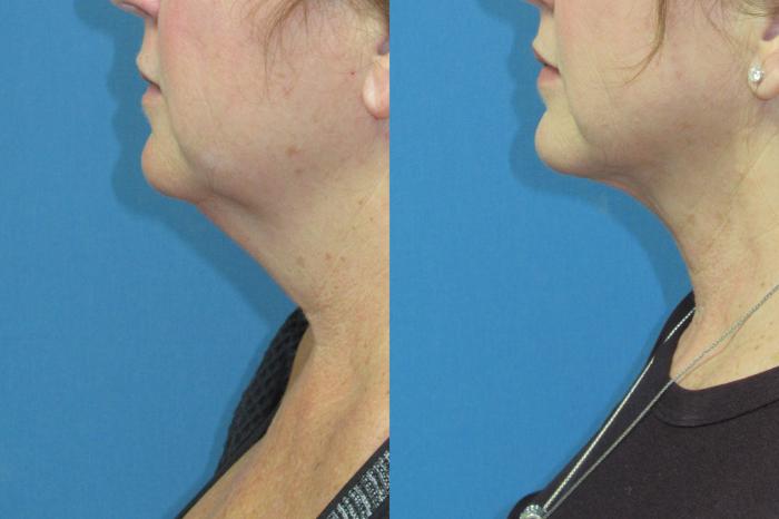 Before & After Liposuction - Neck / Precision TX Face & Neck Case 210 Left Side View in Coeur d'Alene, ID