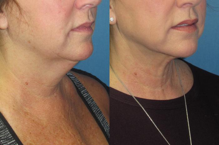 Before & After Liposuction - Neck / Precision TX Face & Neck Case 210 Right Oblique View in Coeur d'Alene, ID