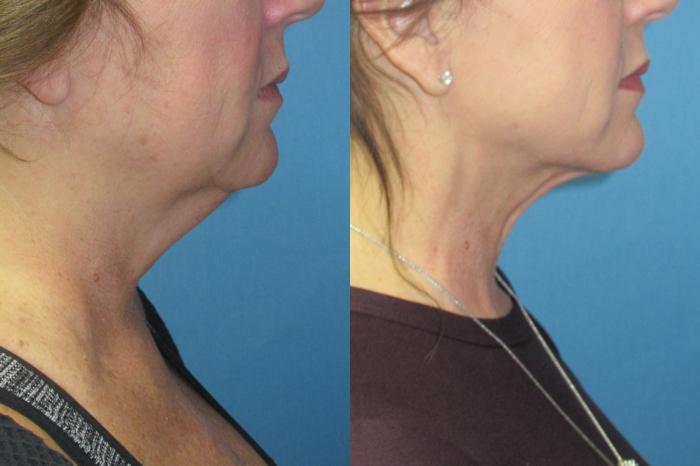 Before & After Liposuction - Neck / Precision TX Face & Neck Case 210 Right Side View in Coeur d'Alene, ID