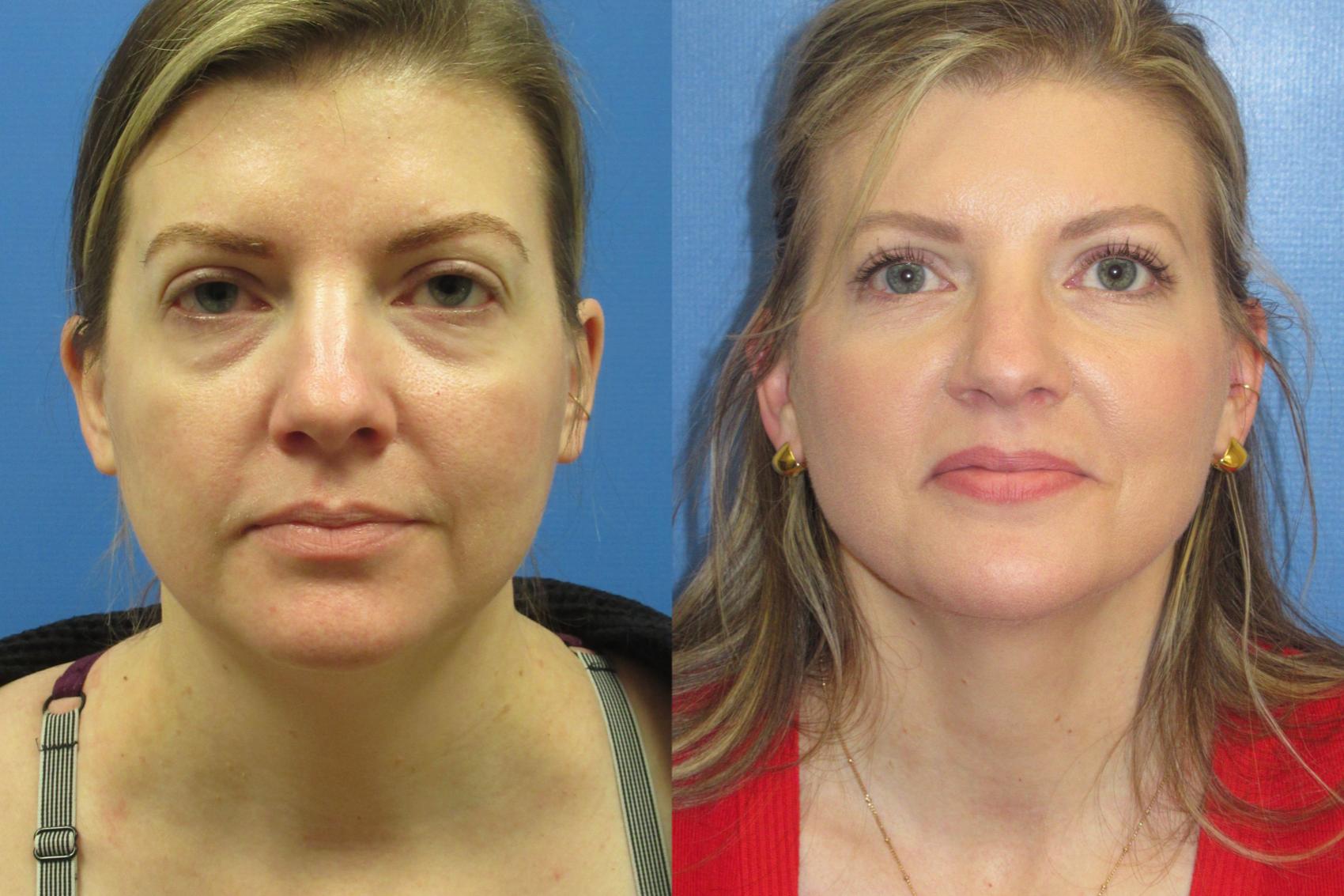Before & After Liposuction - Neck Case 222 Front View in Coeur d'Alene, ID