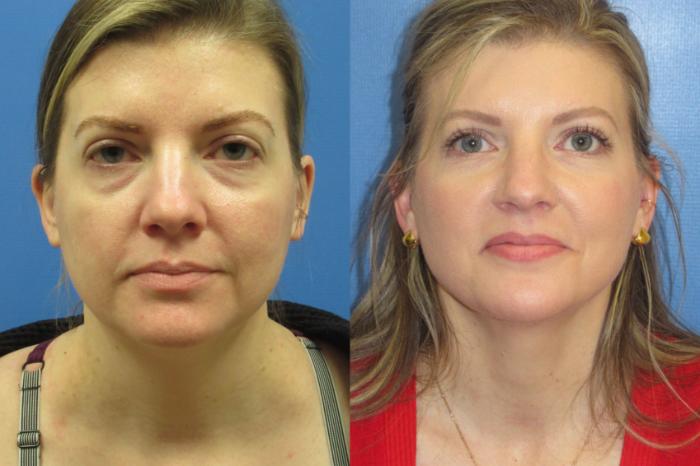 Before & After Liposuction - Neck Case 222 Front View in Coeur d'Alene, ID