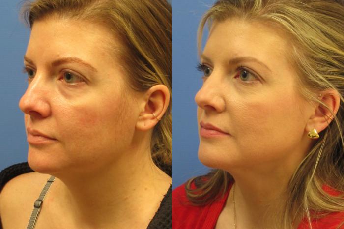 Before & After Liposuction - Neck Case 222 Left Oblique View in Coeur d'Alene, ID