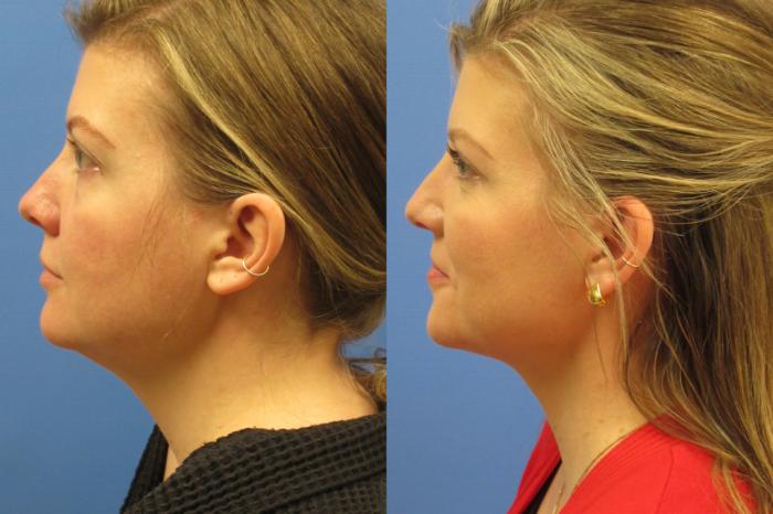 Before & After Liposuction - Neck Case 222 Left Side View in Coeur d'Alene, ID