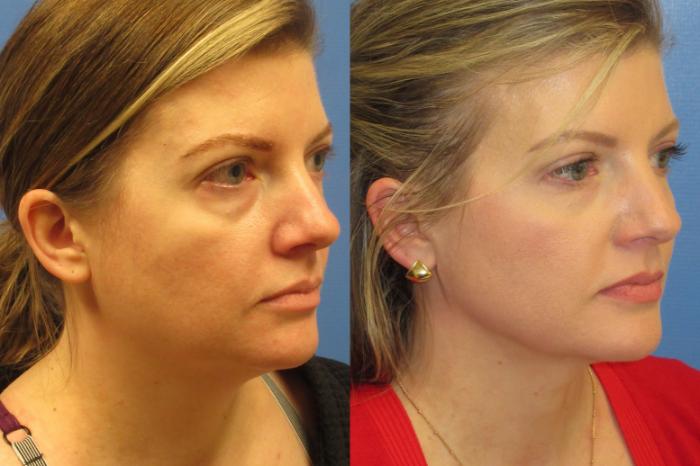 Before & After Liposuction - Neck Case 222 Right Oblique View in Coeur d'Alene, ID