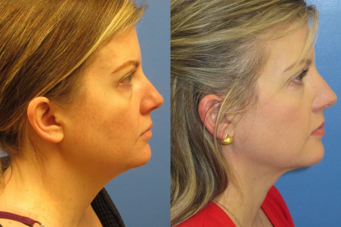 Before & After Liposuction - Neck Case 222 Right Side View in Coeur d'Alene, ID
