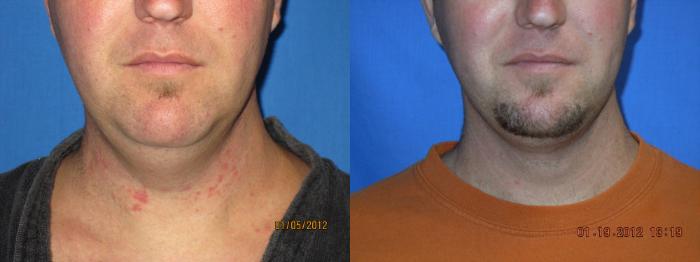 Before & After Laser Skin Rejuvenation Case 24 View #1 View in Coeur d'Alene, ID