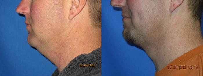Before & After Liposuction - Neck / Precision TX Face & Neck Case 24 View #2 View in Coeur d'Alene, ID