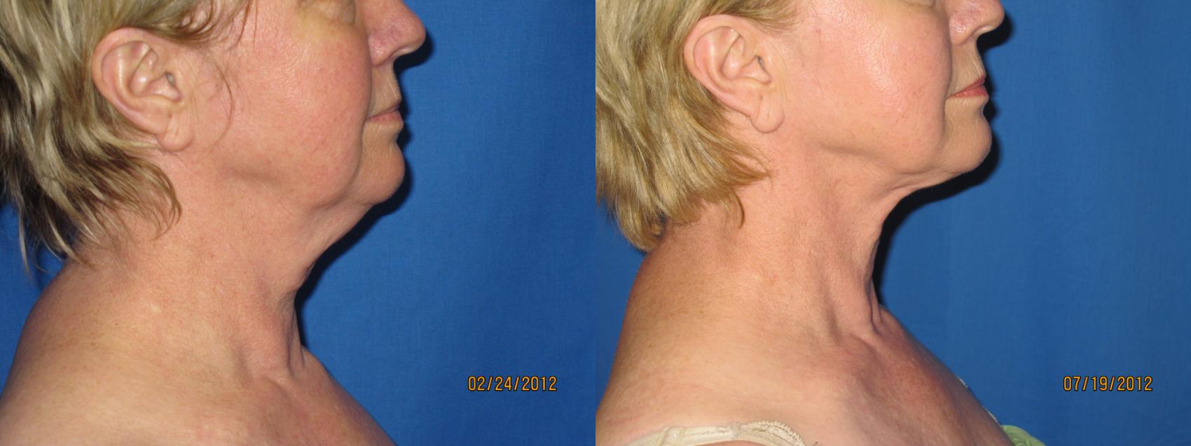 Before & After Liposuction - Neck / Precision TX Face & Neck Case 28 View #1 View in Coeur d'Alene, ID