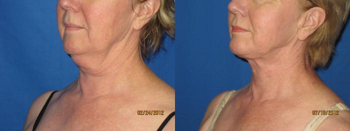 Before & After Liposuction - Neck / Precision TX Face & Neck Case 28 View #2 View in Coeur d'Alene, ID