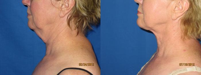 Before & After Liposuction - Neck / Precision TX Face & Neck Case 28 View #3 View in Coeur d'Alene, ID