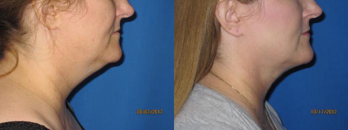 Before & After Liposuction - Neck / Precision TX Face & Neck Case 29 View #1 View in Coeur d'Alene, ID