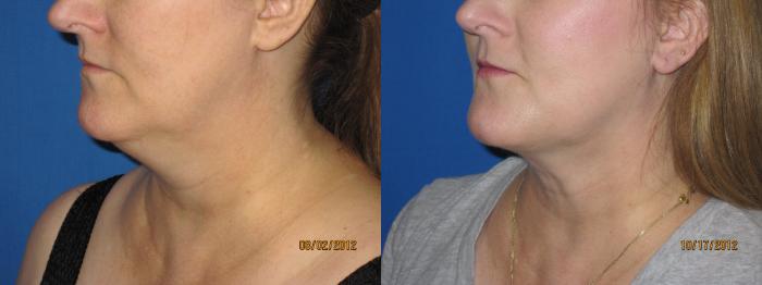 Before & After Liposuction - Neck / Precision TX Face & Neck Case 29 View #2 View in Coeur d'Alene, ID