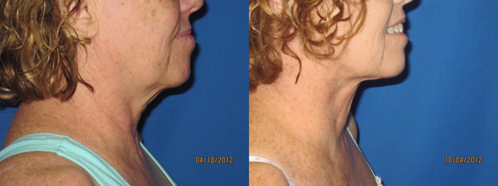 Before & After Liposuction - Neck / Precision TX Face & Neck Case 30 View #1 View in Coeur d'Alene, ID
