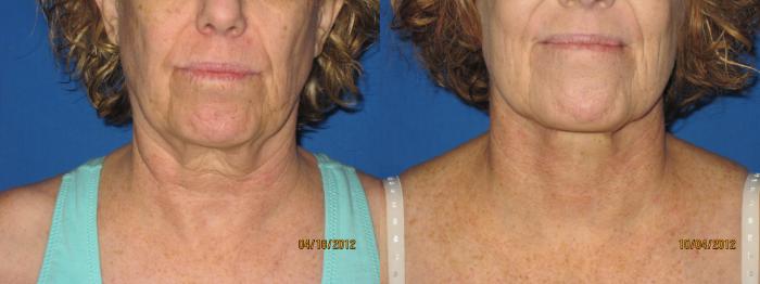 Before & After Liposuction - Neck / Precision TX Face & Neck Case 30 View #2 View in Coeur d'Alene, ID
