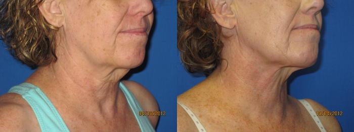 Before & After Liposuction - Neck / Precision TX Face & Neck Case 30 View #4 View in Coeur d'Alene, ID