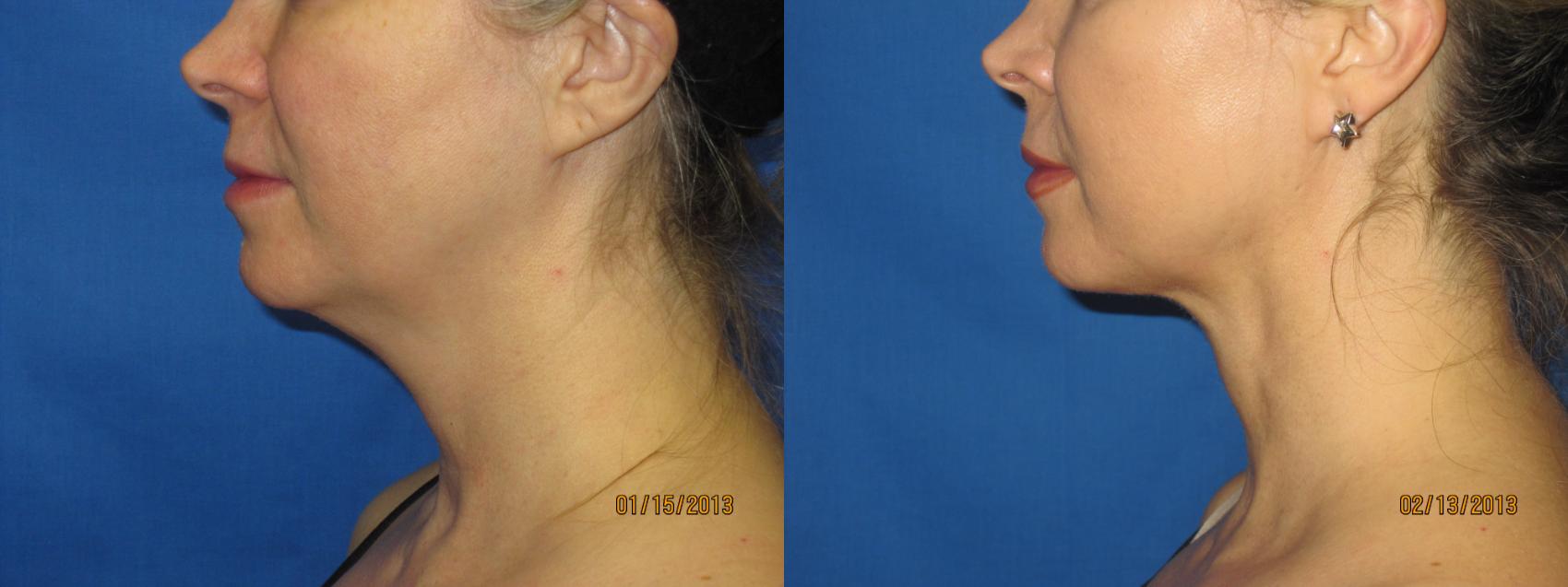 Before & After Liposuction - Neck / Precision TX Face & Neck Case 45 View #1 View in Coeur d'Alene, ID