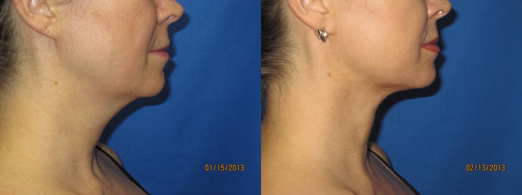 Before & After Liposuction - Neck / Precision TX Face & Neck Case 45 View #2 View in Coeur d'Alene, ID