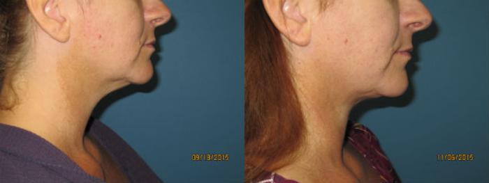 Before & After Liposuction - Neck / Precision TX Face & Neck Case 64 View #1 View in Coeur d'Alene, ID