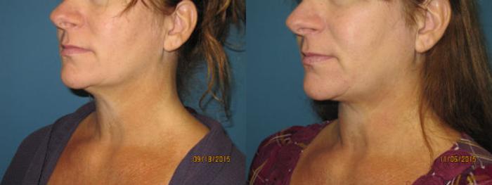 Before & After Liposuction - Neck / Precision TX Face & Neck Case 64 View #2 View in Coeur d'Alene, ID