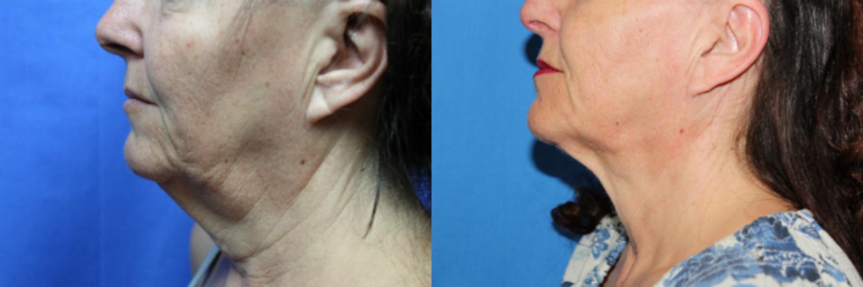 Before & After Liposuction - Neck / Precision TX Face & Neck Case 66 View #1 View in Coeur d'Alene, ID