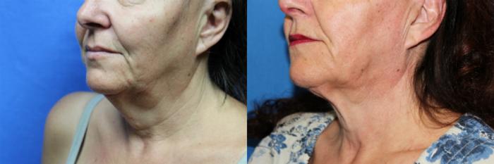 Before & After Liposuction - Neck / Precision TX Face & Neck Case 66 View #2 View in Coeur d'Alene, ID