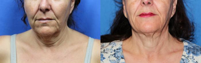 Before & After Liposuction - Neck / Precision TX Face & Neck Case 66 View #3 View in Coeur d'Alene, ID