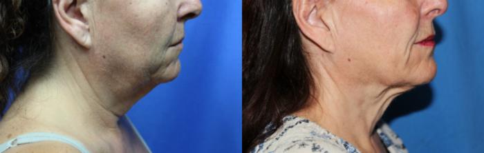 Before & After Liposuction - Neck / Precision TX Face & Neck Case 66 View #4 View in Coeur d'Alene, ID